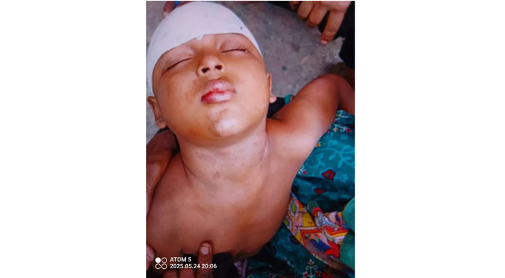 এ কেমন বর্বরতা রূপগঞ্জে পূর্ব শত্রুতায় শিশুকে কুপিয়ে জখম