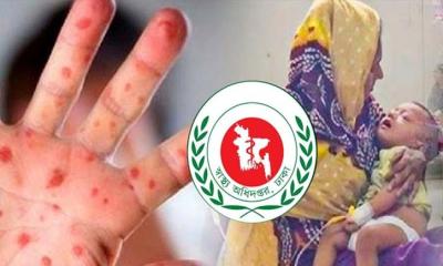হাম ও হামের উপসর্গে আরও ৭ জনের মৃত্যু