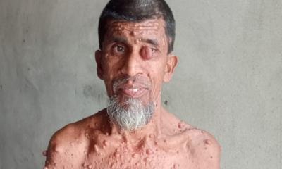 বাঁচতে চান, ১০ বছর ধরে বিরল রোগে আক্রান্ত হাবিবুল্লাহ
