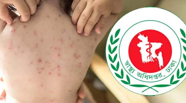 হামের উপসর্গে আরও ৩ জনের প্রাণহানি