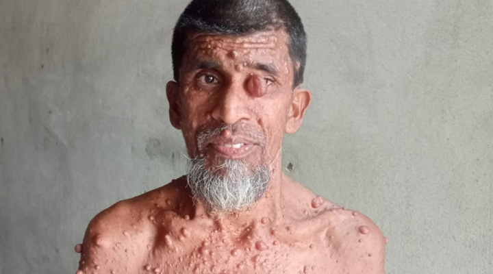 বাঁচতে চান, ১০ বছর ধরে বিরল রোগে আক্রান্ত হাবিবুল্লাহ