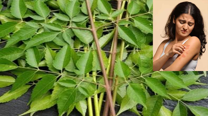গরমে ঘামাচি-চুলকানিতে  নিমপাতা ব্যবহার